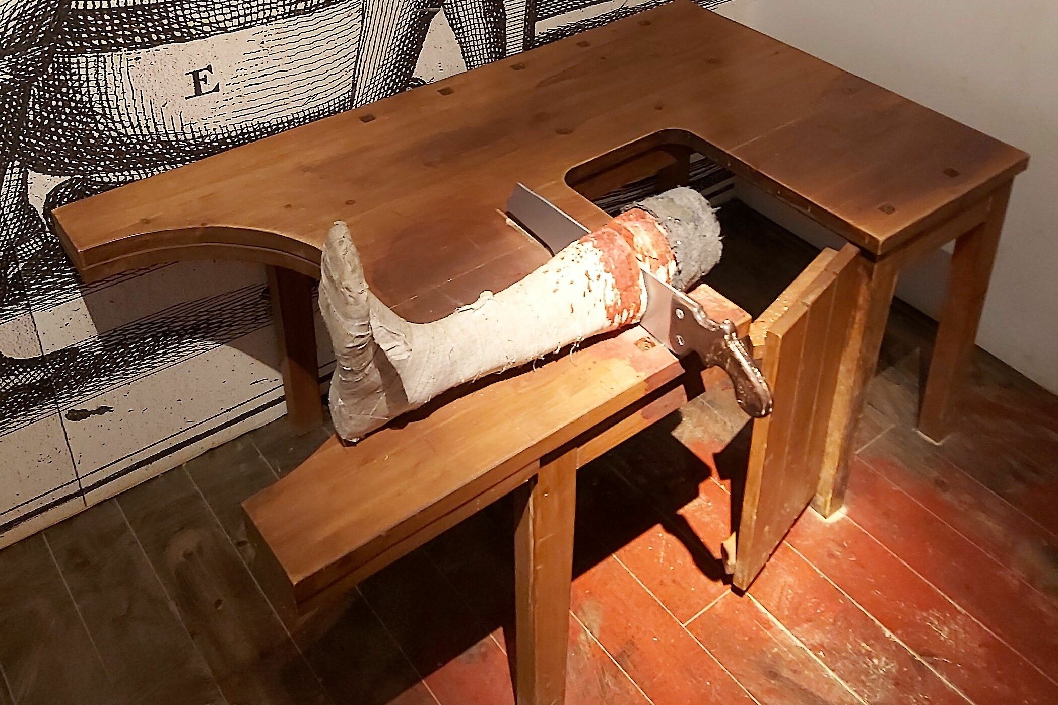 Een beenamputatie in het mijnmuseum.